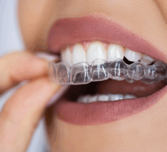 Clear Aligners