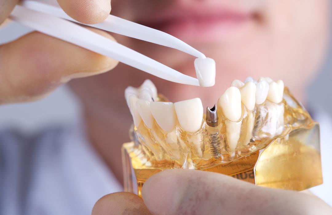 Dental Implants