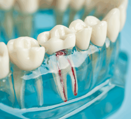 Root Canal