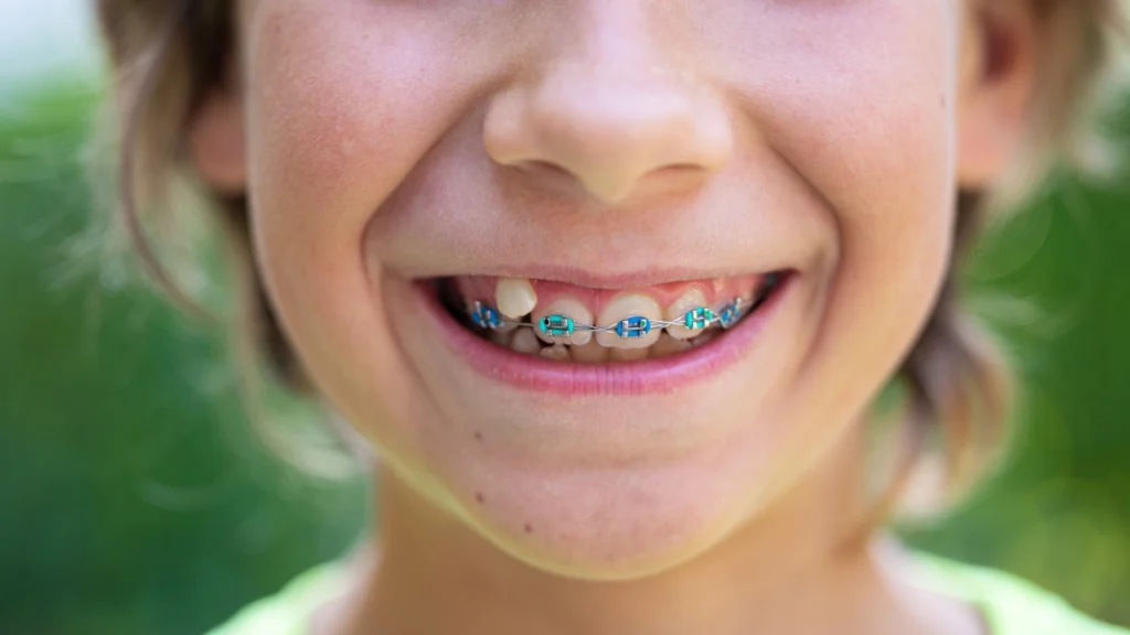 Kids Braces